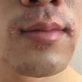 トリア髭脱毛での毛嚢炎