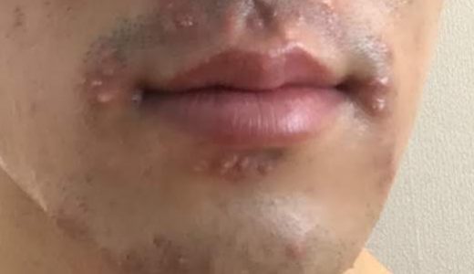 【※画像あり】家庭用脱毛器を毎日やってみた結果… VIOと髭への効果と副作用とは？