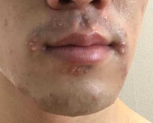 トリア髭脱毛での毛嚢炎