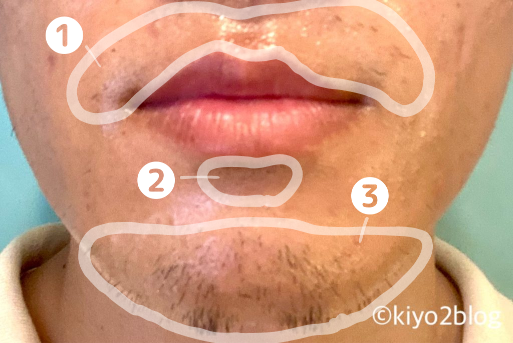 トリアは髭脱毛に効果ある10回目