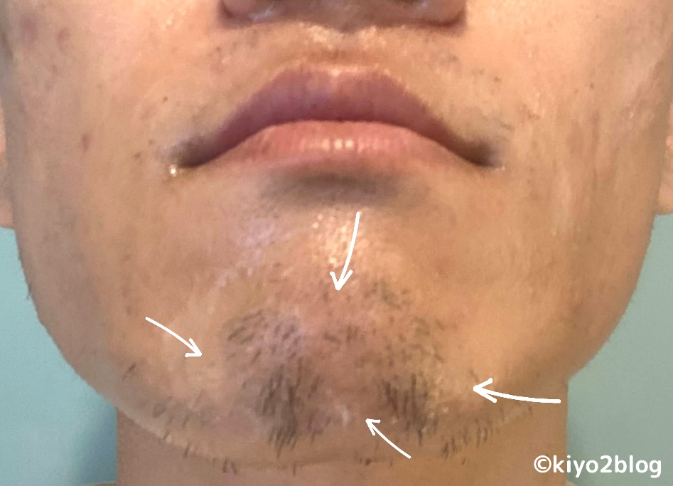 トリアは髭脱毛に効果ある10回目