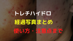 【ブログ】トレチノインとハイドロキノン本気の経過写真！シミ・色素沈着に毎日塗ってみた結果