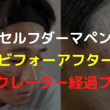 キヨキヨ【完全ビフォーアフター】4年間のセルフダーマペン クレーター肌治療 経過ブログ