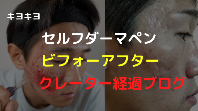 キヨキヨ【完全ビフォーアフター】4年間のセルフダーマペン クレーター肌治療 経過ブログ
