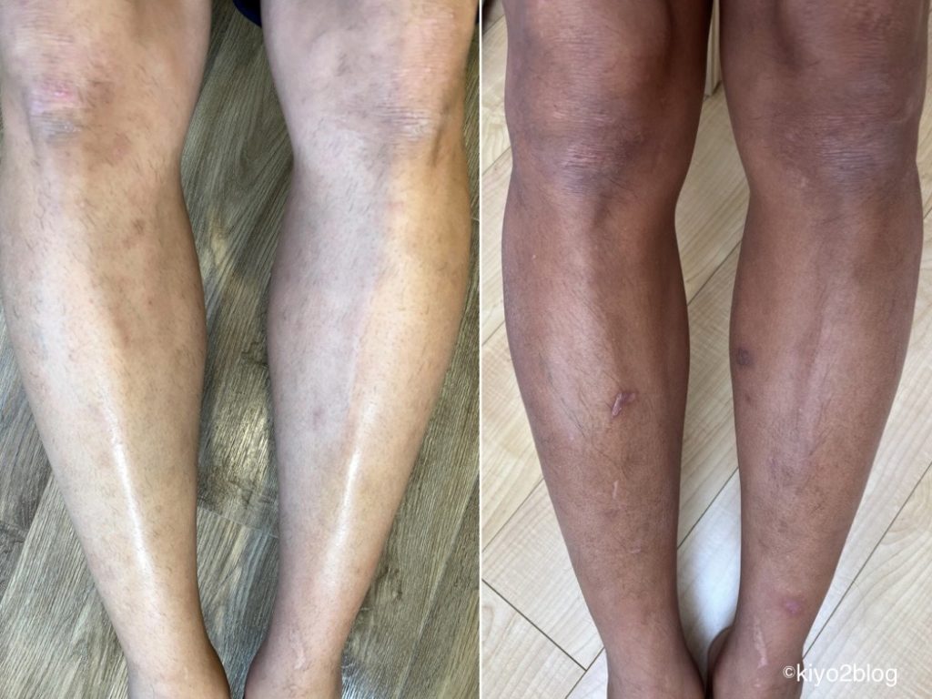 男の剛毛すね毛　脱毛前