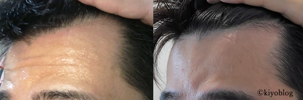 生え際ビフォーアフター