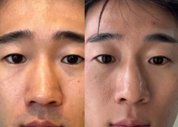 トリア　眉間顔脱毛