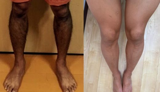 【本音】家庭用脱毛器を5年使った効果をぶっちゃけます。医療脱毛と比較してどう？