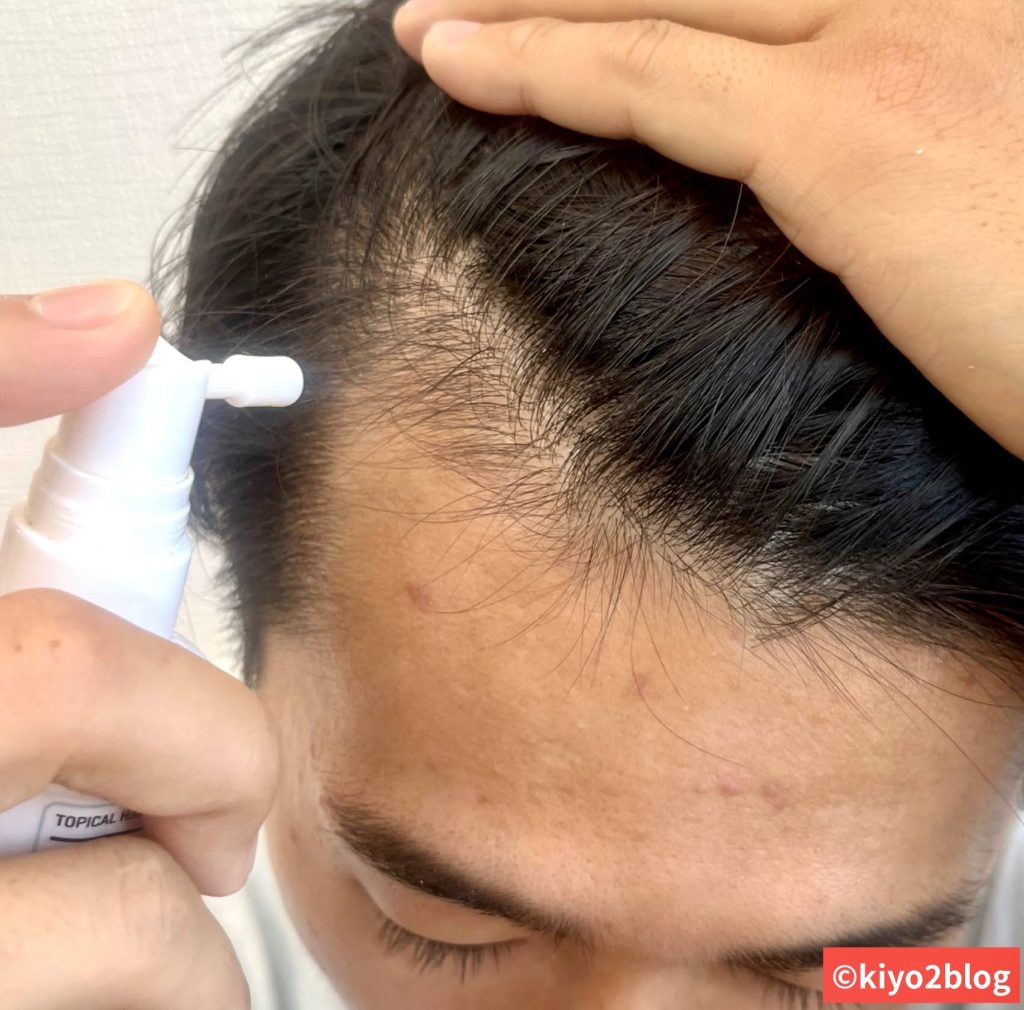 ミノキシジルの発毛効果