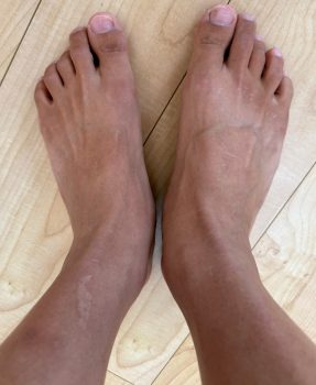 トリアで足の指を脱毛