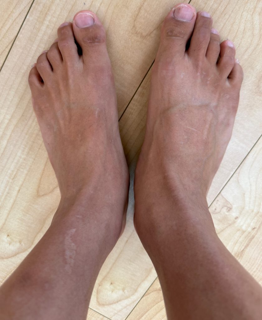 トリアで足の指を脱毛