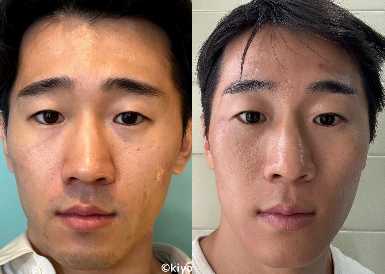 トリアの顔脱毛ビフォーアフター