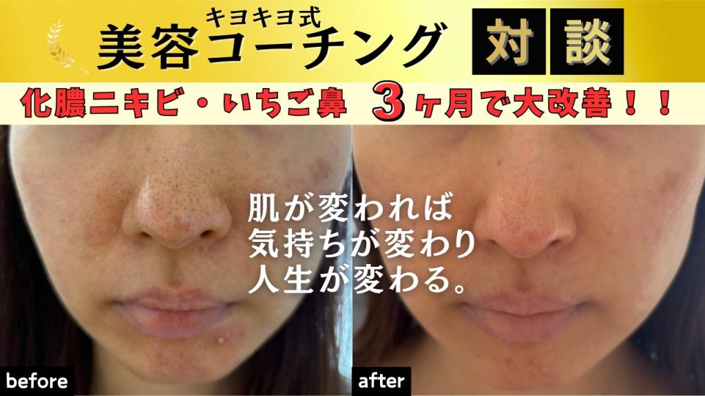 化膿ニキビ・いちご鼻が３ヶ月で大改善！？肌が変わると人生が変わります✨【キヨキヨ式美容コーチング対談】