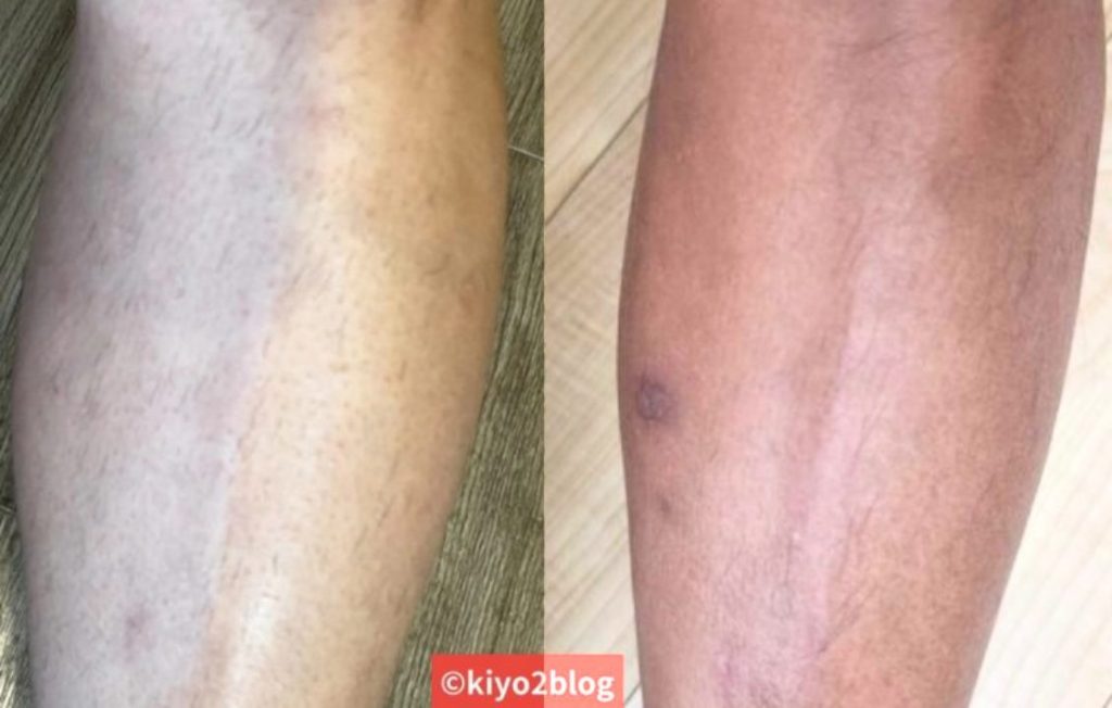 トリアですね毛脱毛