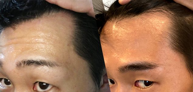 ミノキシジルを塗って3ヶ月