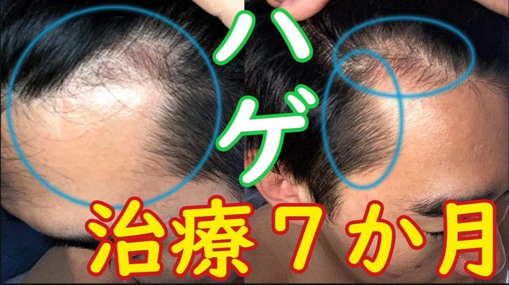 ダーマローラーとミノキシジル