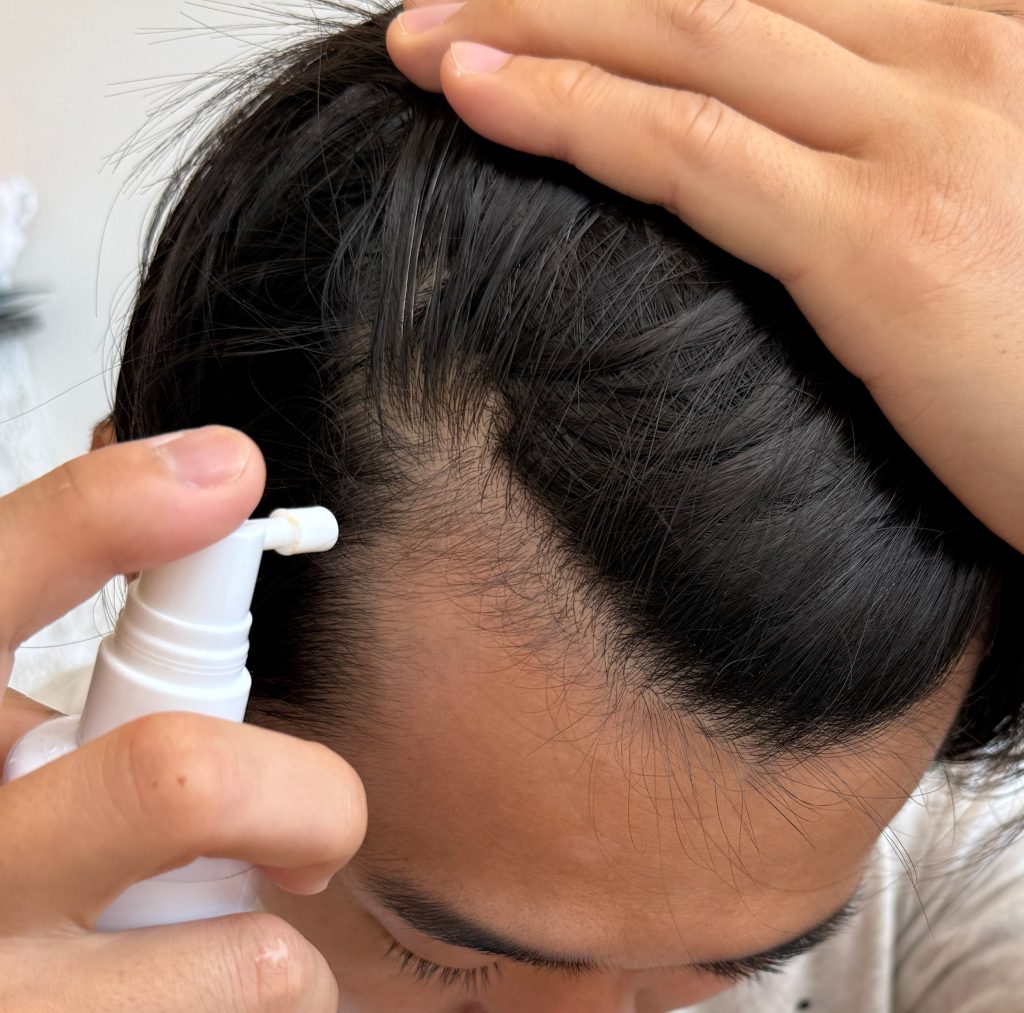 ダーマローラーとミノキシジル