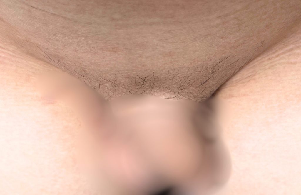 VIO家庭用脱毛器経過　Vライン