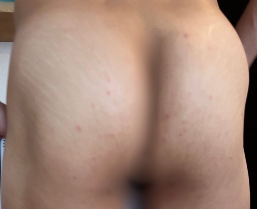 家庭用脱毛器でVIO脱毛を毎日やってみた