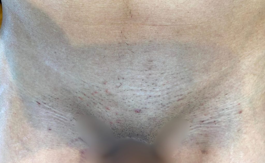 VIO家庭用脱毛器経過