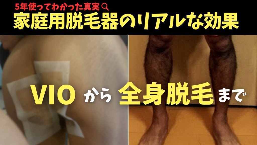 ケノンを使った5年後のリアルな経過。家庭用脱毛器で本当に全身脱毛できるのか…？
