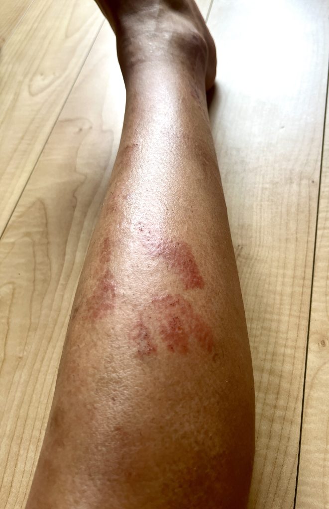 家庭用脱毛器でヤケド