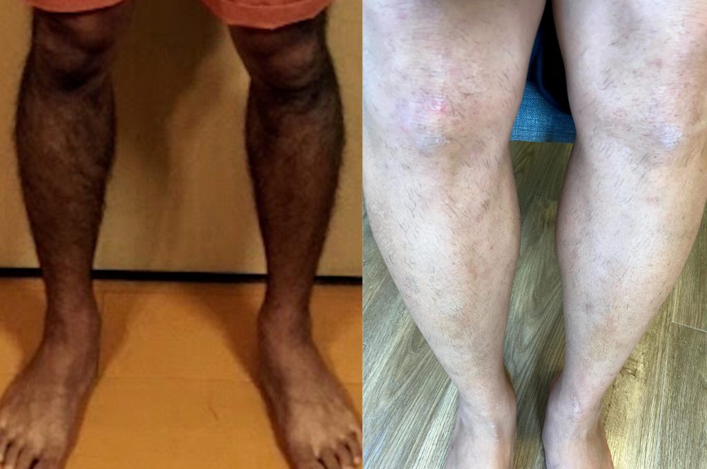 すね毛ケノンビフォーアフター