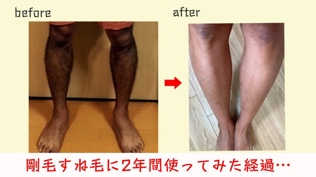 ブラウン シルクエキスパート pro5 の経過！リアルな口コミとレビューを集めてみた結果、、、